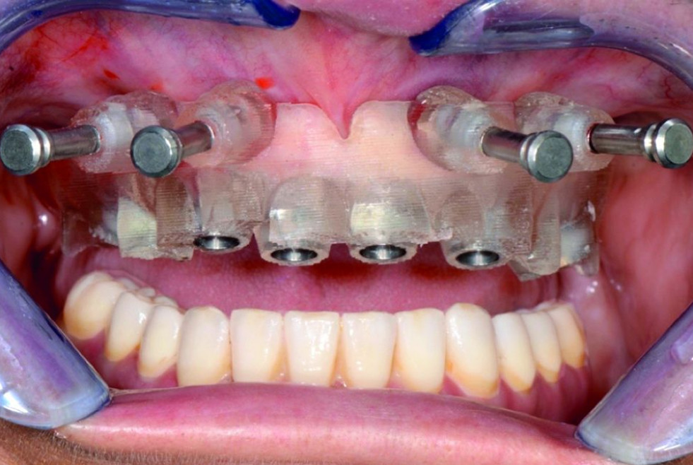 DM24_OdontologiaDigital_protesis