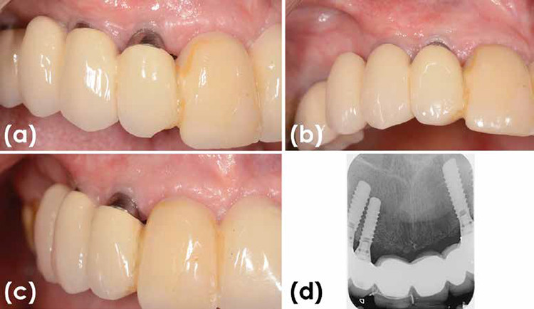 Figura 1. a) Recesión vestibular de la mucosa periimplantaria de 2mm en implante en 12 . b) Vista oclusal de la recesión.  c) Vista de perfil de la recesión. d) Radiografía periapical del implante