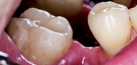 Close up picture odental problems, missing tooth.