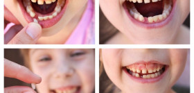 AvulsionesDentalesNiiños123rf2