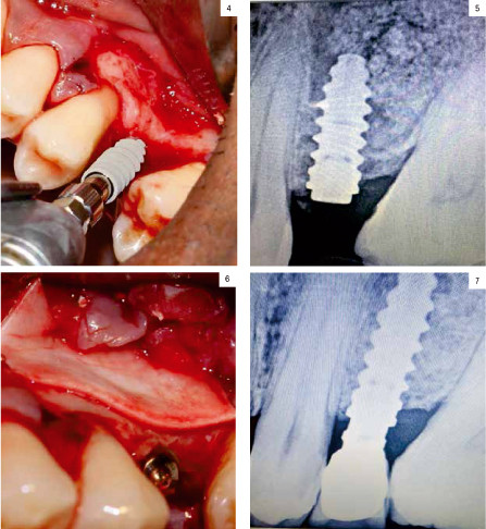 Colocación de implantes de forma simultánea a elevación de seno lateral en maxilares con atrofia severa. Serie de casos