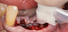 9-Caso_Nobel_Implantología_DM67