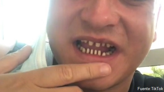 Turkey Teeth tiktok