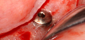 Figura 6 caso implantología Anitua DM69