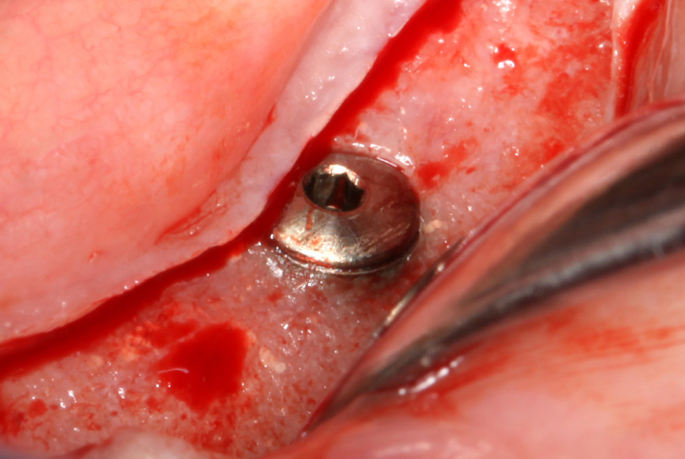 Figura 6 caso implantología Anitua DM69