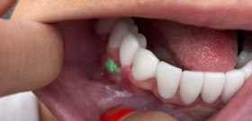 Turkeyteeth tiktok