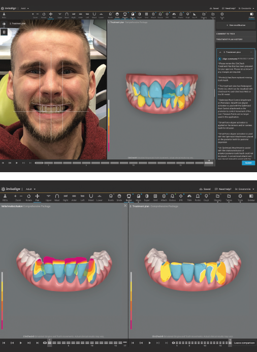 Invisalign Smile Architect2