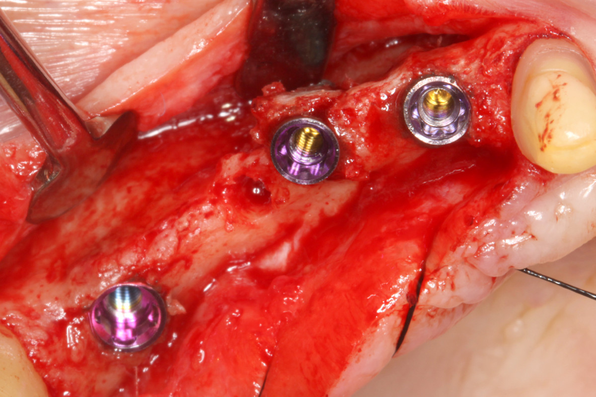 Figura 10 caso implantologia DM73