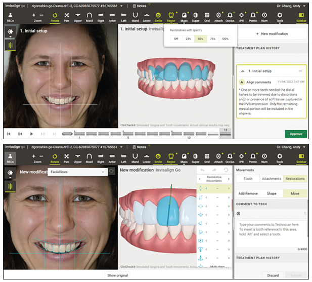 Align smile architect dm78