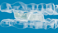 Invisalign Full Size JPG MAOB Closeup Blocks BLUE