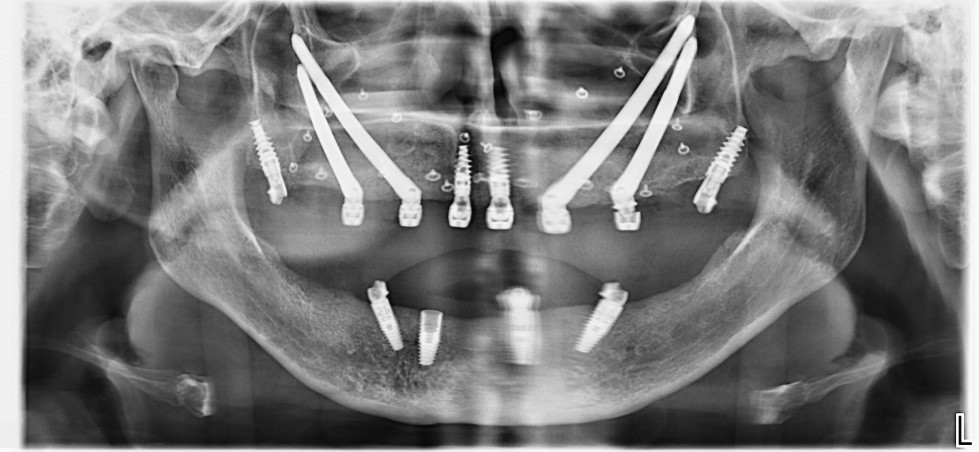 Foto 13 caso nobel biocare dm94