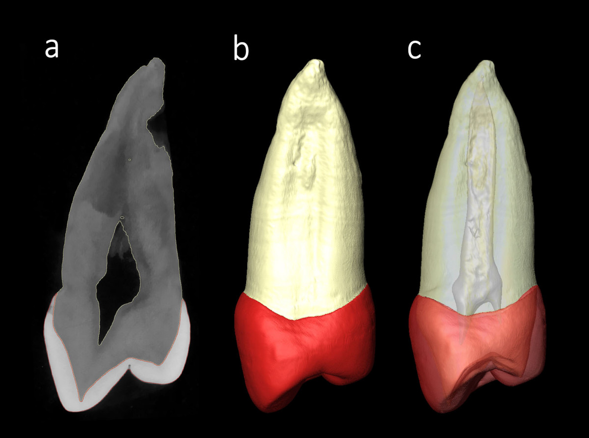 NP enamel thickness premolars