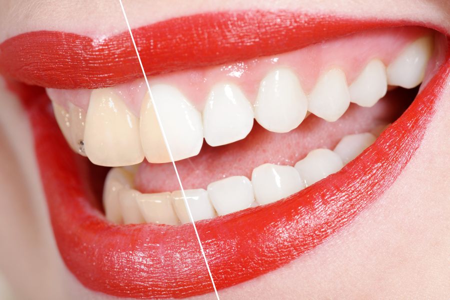 123rf-before and after the tooth whitening