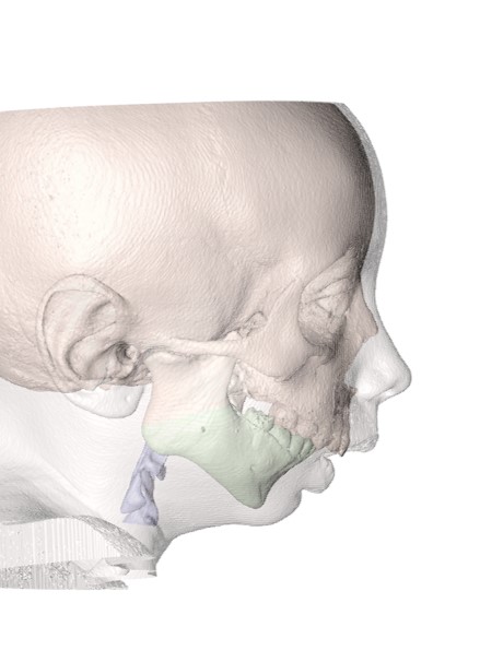 Figura 3. Paciente pediátrico con SAOS severo.