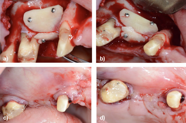 Figura 5. a) Imagen vestibular de las láminas autónomas fijadas. b) Imagen oclusal de las láminas autónomas fijadas. c) Imagen vestibular de la sutura. d) Imagen oclusal de la sutura. FOTO: Grupo PerioCentrum