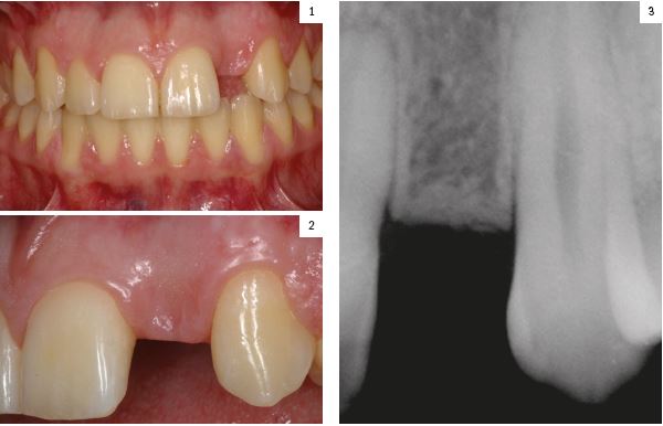 Figuras 1-2. Imágenes iniciales de la paciente donde podemos observar la ausencia de un incisivo lateral izquierdo con un espacio mesio-distal protésico ligeramente reducido. Figura 3. Con la radiografía periapical con paralelizador puede observarse además que el espacio a nivel óseo (quirúrgico) es menor aún.