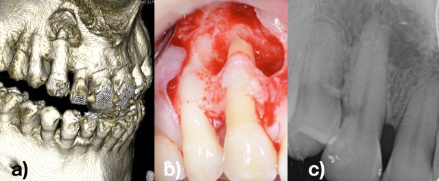 Imagen Figura 8 correspondiente al caso de Periodoncia Multidisciplinar titulado "Lesiones endo-periodontales: diagnóstico, clasificación, tratamiento y pronóstico" (artículo cedido por PerioCentrum).