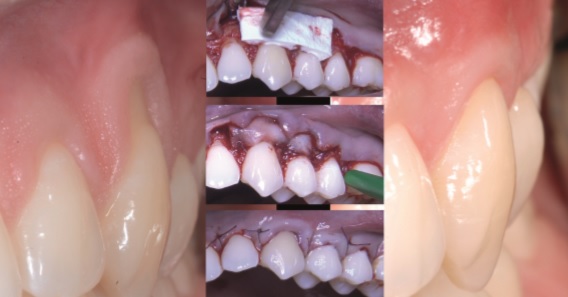 Procedimiento de cobertura radicular en diente en posición de 23 mediante técnica de colgajo de avance coronal combinado con la utilización de una matriz colágena y resultados a 12 meses de seguimiento.