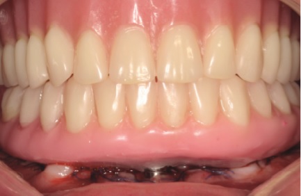 Prótesis atornillada a los implantes