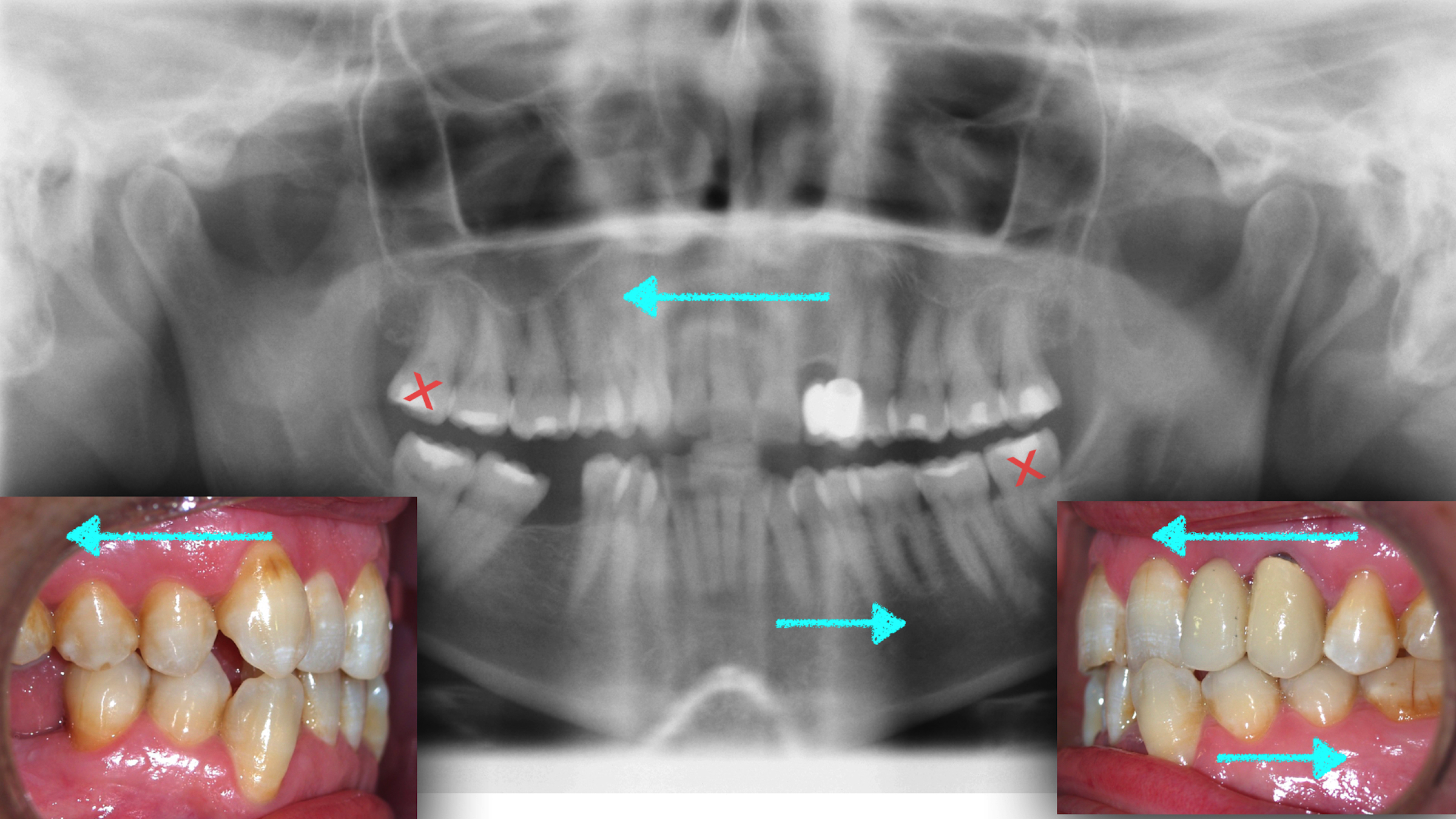 Fig. 7. Dirección de los movimientos planificados para cada arcada y hemiarcada. Extracciones seleccionadas.