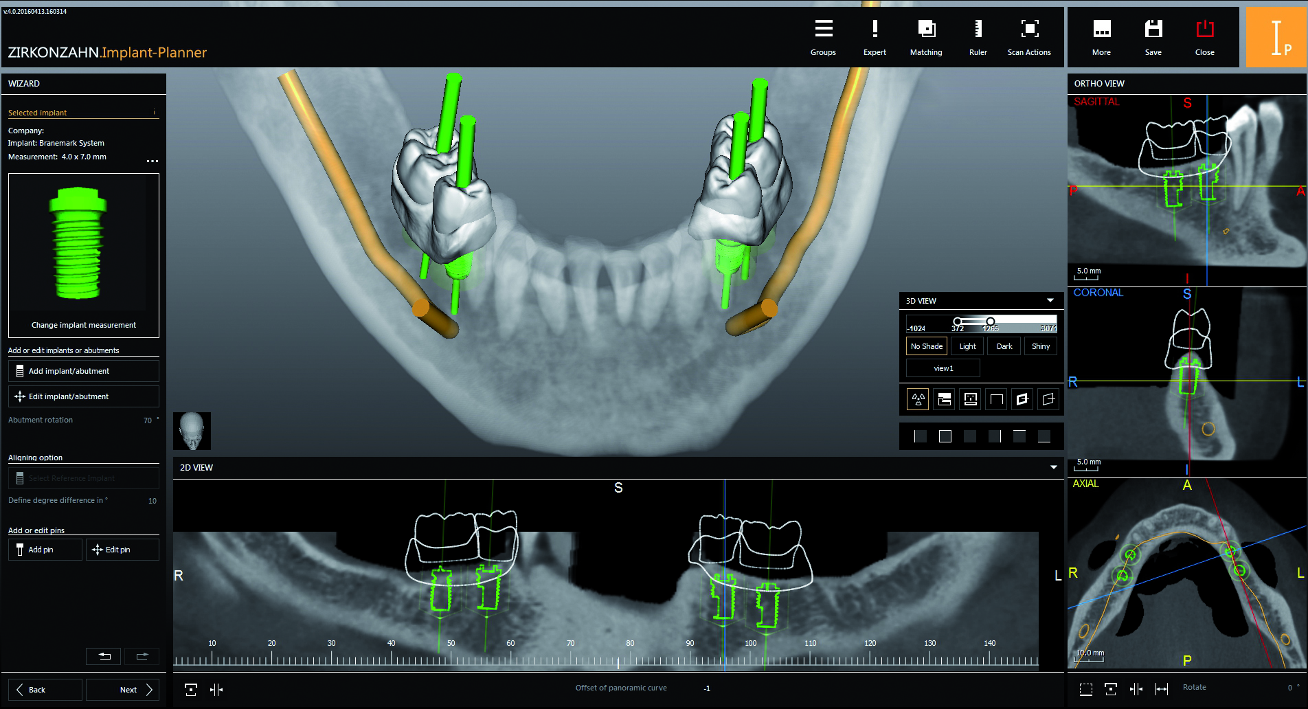Este software guía al dentista paso a paso en la planificación del implante. 