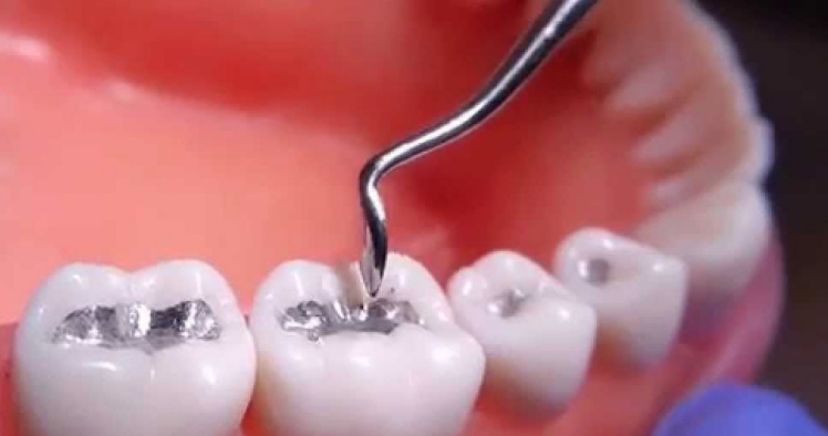 El estudio demuestra que, en nuestro país, el 92% de los dentistas ha disminuido la utilización de amalgamas dentales en un 50% en los últimos 5 años. FOTO: Consejo General de Dentistas