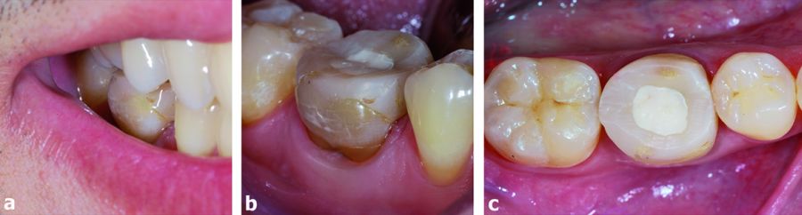 Vestibular and occlusal aspect