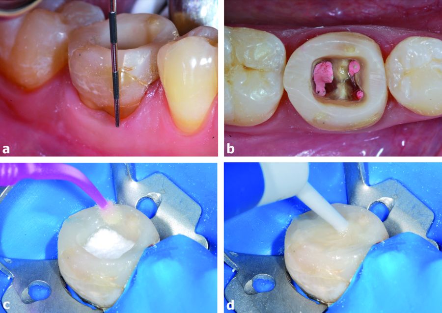 4. Blanqueamiento del diente antes del tratamiento. a) y b) El nivel de la encía vestibular define la cantidad de gutapercha a eliminar de la parte cervical de las raíces. c) En la cavidad se introduce una mezcla de perborato de sodio y peróxido de hidrógeno al 3% mientras se aplica y se polimeriza en los bordes un estrato de resina compuesta adhesiva. d) La cavidad se rellena fácilmente con la resina fluida como obturación provisional y polimerizada.