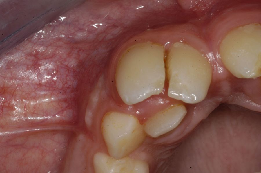 Visión axial de parte de la hemiarcada derecha en un caso de dientes supernumerarios.