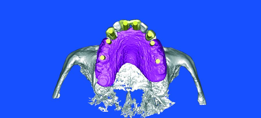 Vista oclusal de las emergencias de los implantes respecto a las piezas y la férula rediográfica.