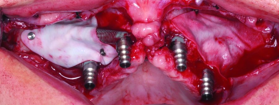 Cobertura de implantes.