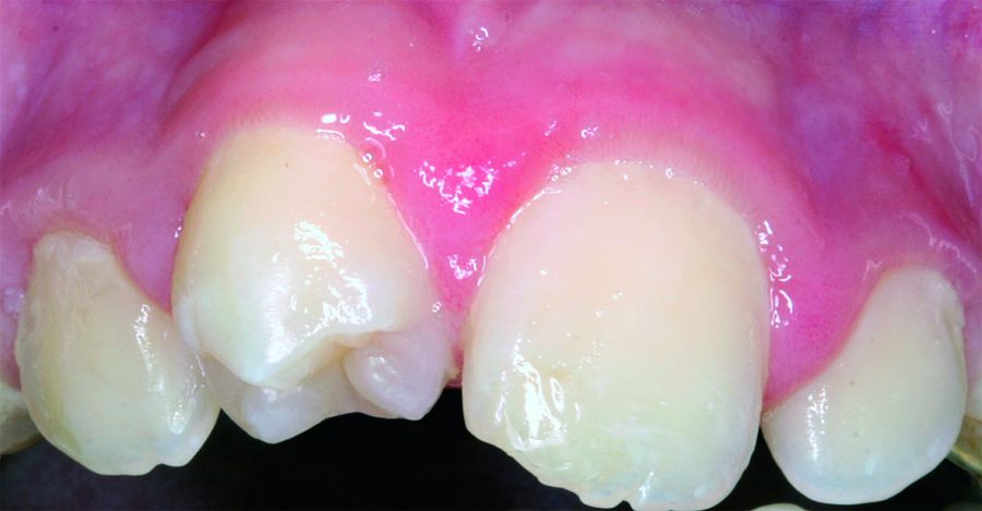 Tooth 1.1(4.4.) one month after tooth autotransplantation