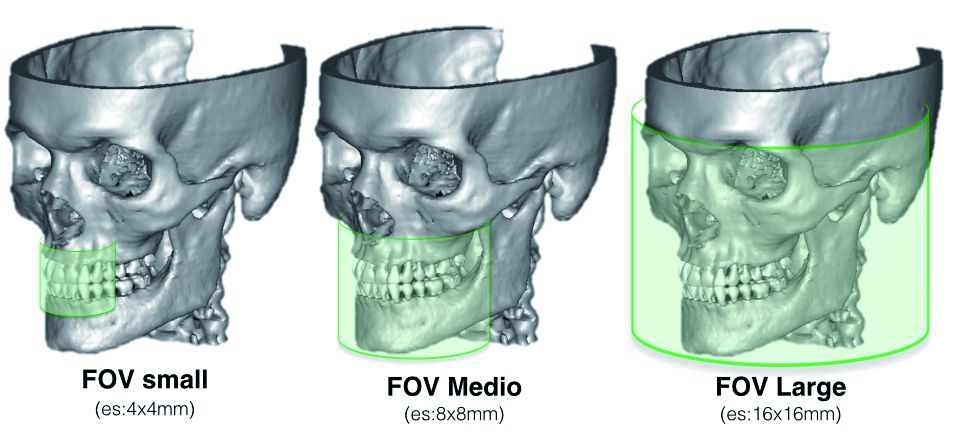 Representación gráfica de la zona del cráneo cubierta por el FOV.