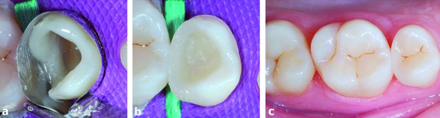 2. Estratificación de la resina compuesta. a) Inicialmente, la pared interproximal distal está estratificada con varios incrementos. b) Se elimina la matriz metálica y se procede a la reconstrucción de la parte oclusal. c) Visión oclusal de la zona después de una semana.