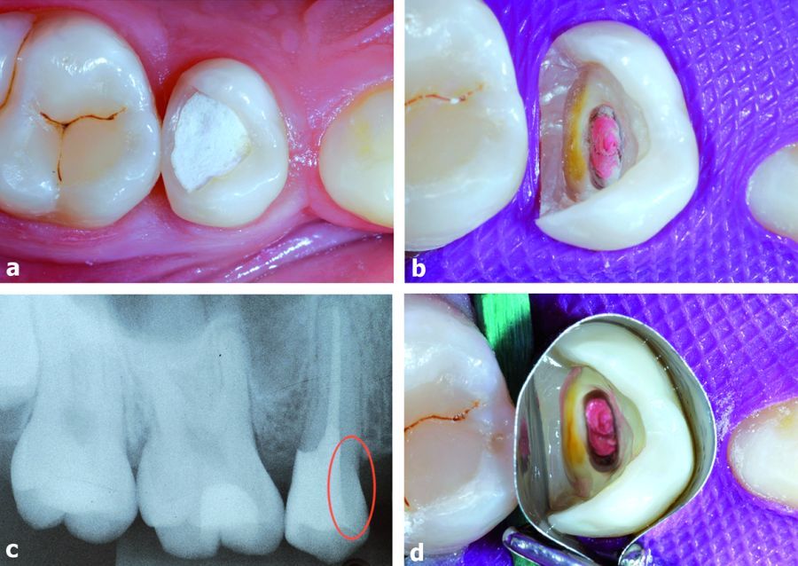 1.a) Imagen inicial del diente 15 desvitalizado. El primer premolar se extrajo por razones ortodónticas. b) Se ha limpiado la cavidad. La parte distal de la resina de reconstrucción pre-endodóntica se ha mantenido con el fin de evitar la necesidad de una preparación subgingival. c) Mediante rayos X se ha comprobado el espesor de la pared mesial. d) Aspecto brillante de la cavidad después de la aplicación del sistema adhesivo.