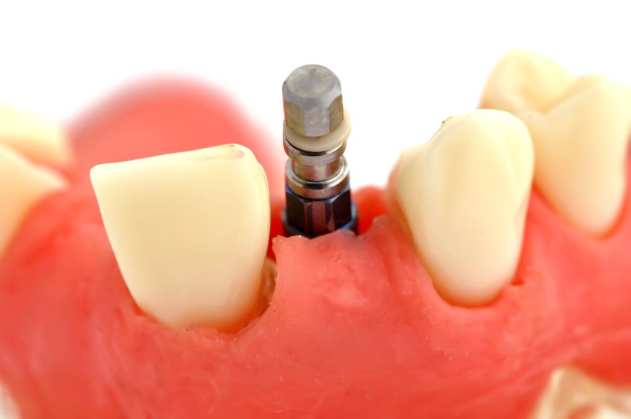 En España se colocan entre 1.200.000 y 1.400.000 millones de implantes dentales al año. 