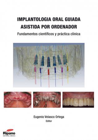 Implantología Oral Guiada