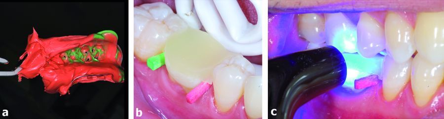 6. Impression and temporization of the cavity