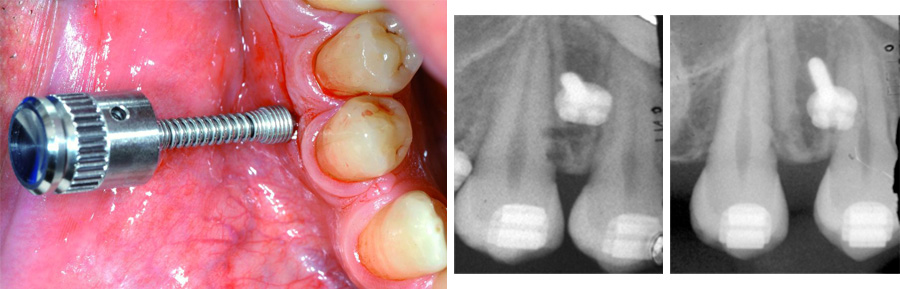 Inserción de un minitornillo en contacto con la raíz del diente.