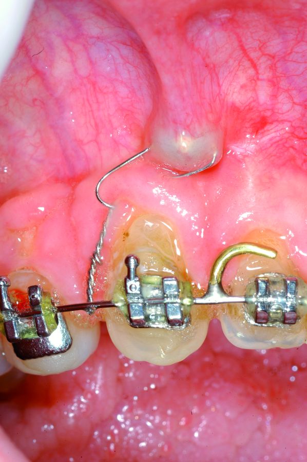 4. Inserción del minitornillo en la mucosa alveolar. En la foto se puede apreciar el encapsulamiento del minitornillo.