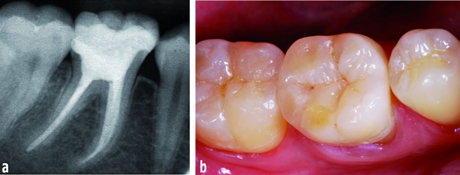 The radiographic (a) and clinical (b) aspect