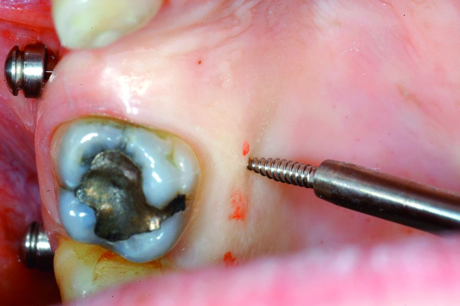 2. Colocación correcta de un minitornillo en la zona palatal.