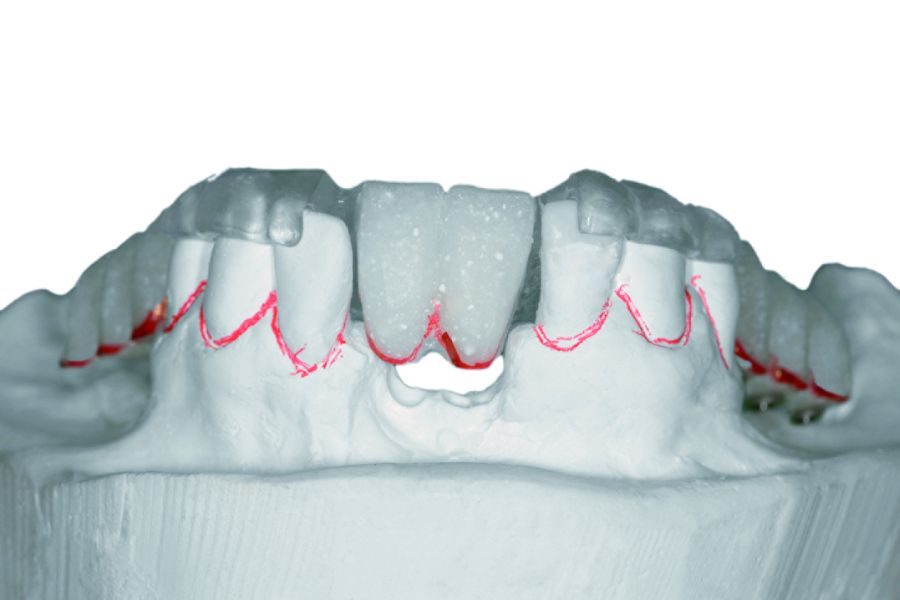 Molde quirúrgico vinculante para la misma posición implantaria sobre la base del set-up ortodóntico.