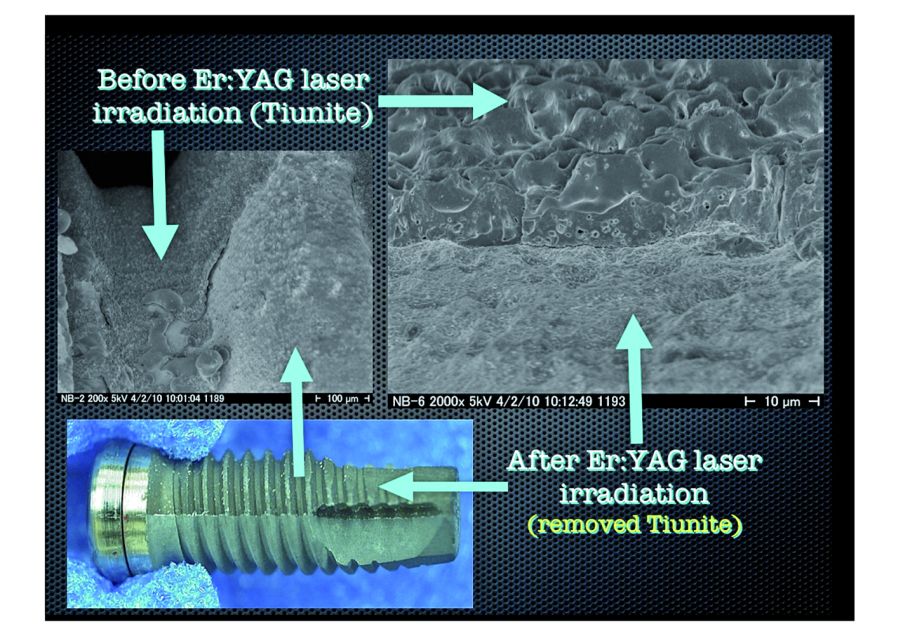 1.Phase Contrast Electron Micrographs. TiUnite layer has been completely stripped away with micro-explosions. Newly exposed surface has not been melted or otherwise deformed by the heating effect of laser irradiation.