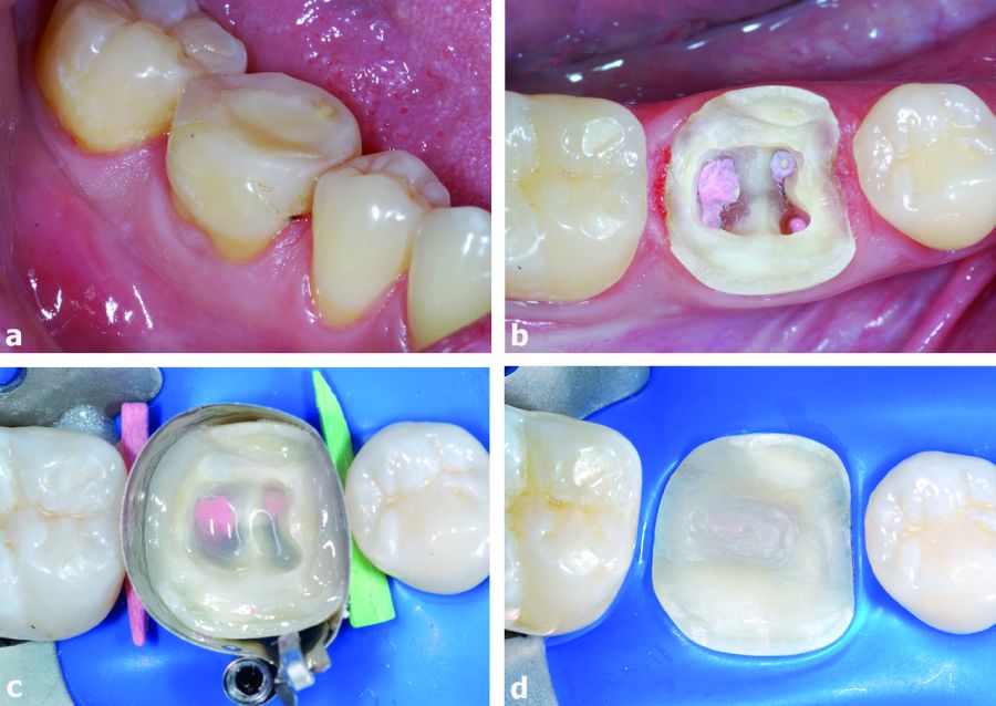 5. Preparación de la cavidad para la reconstrucción indirecta. a) Después de una semana se ha reducido la discromía y el diente está listo para ser preparado. b) Se retira el composite antiguo y se bajan las cúspides de 2-3 mm. c) Se aísla la cavidad y se trata adhesivamente. Se aplica la resina compuesta híbrida en los box mesiales y distales para reubicar el margen más coronalmente. El uso de una resina transparente en la primera parte de la cámara pulpar facilita la detección delos canales radiculares en caso de retratamiento endodóntico. d) Renovación del esmalte lingual y vestibular. Toda la dentina está recubierta de una fina capa de resina. La cavidad está lista para la toma de la impresión.