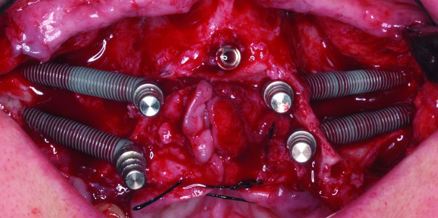 Quad de rescate en fracaso de implantes previos.