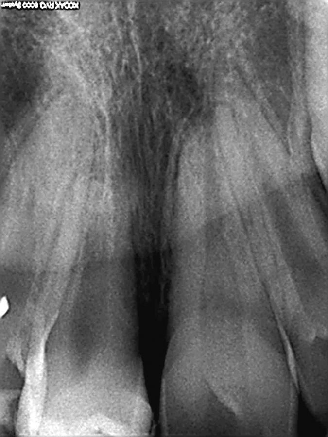 9. Raíz del diente  a los dos meses tras el autotransplante.