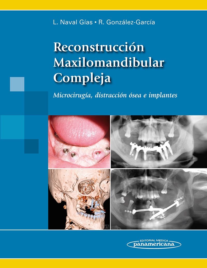 Reconstrucción Maxilomandibular