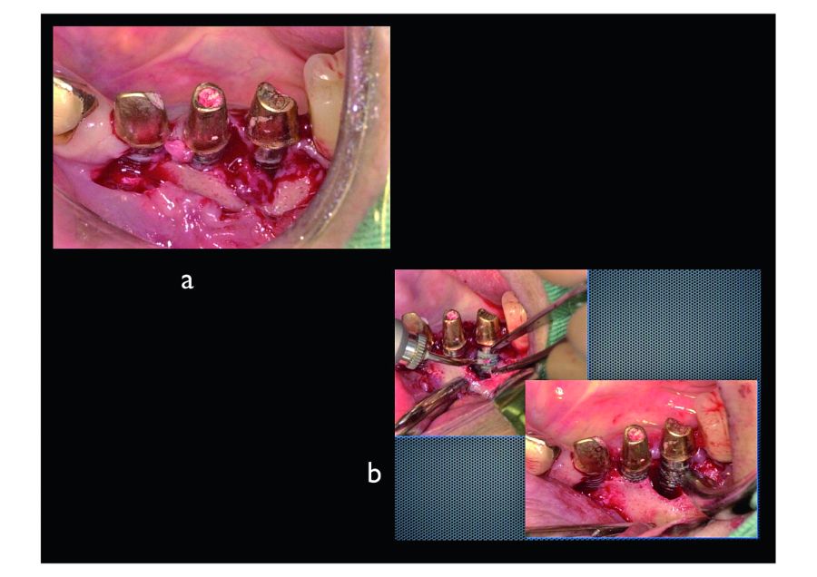 2. The key to removing contaminated granulation tissue with an Er:YAG laser is not to irradiate the granulation tissue itself but to irradiate the layer where the granulation tissue and healthy bone tissue meet. In this way the contaminated granulation tissue can be removed in a single mass. After removing the granulation tissue, we stripped away and sterilized a layer of the contaminated TiUnite surface. 