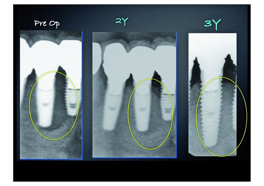 Estas radiografías se realizaron 2 y 3 años después del tratamiento.